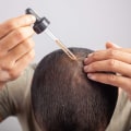 Understanding the Benefits of Minoxidil for Hair Loss