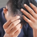 The Link Between Stress and Hair Loss: What You Need to Know