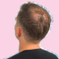 Diagnosing Male Pattern Baldness: A Comprehensive Guide