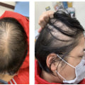 Diagnosing Female Hair Loss: Understanding the Causes and Finding Effective Treatments