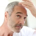 Natural Remedies for Male Pattern Baldness: A Comprehensive Guide