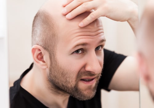 Understanding Hereditary Hair Loss: Causes and Genetics