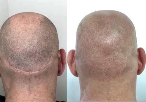 How to Master Scalp Camouflage Techniques for Job Seekers