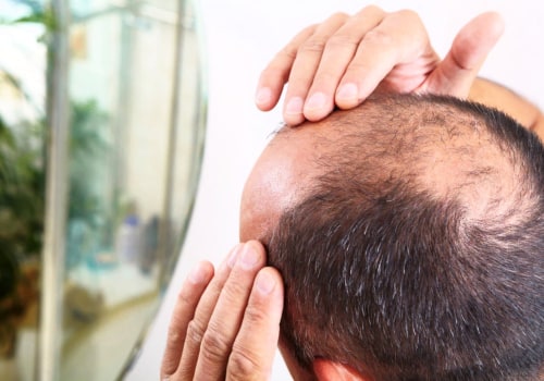 Understanding Medical Treatments for Male Pattern Baldness