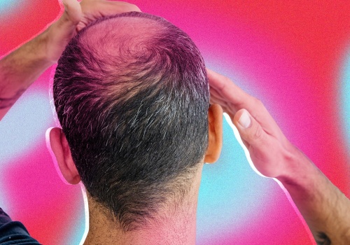 Hair Care Routine for Managing Male Pattern Baldness