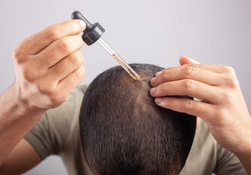 Understanding the Benefits of Minoxidil for Hair Loss