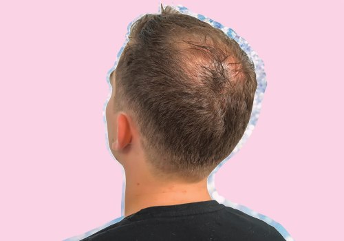 Diagnosing Male Pattern Baldness: A Comprehensive Guide