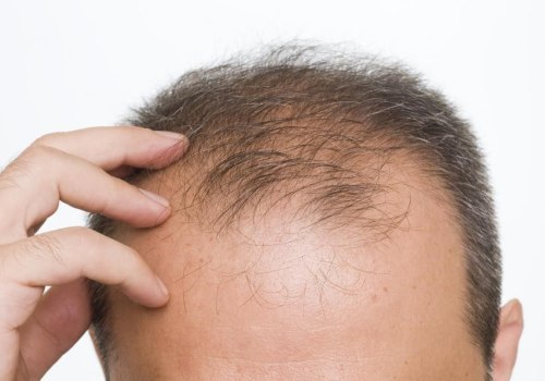 Smoking and Hair Loss: The Connection You Need to Know