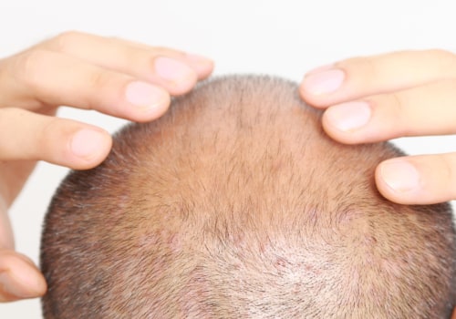 Understanding Alopecia: A Comprehensive Guide for Job Seekers