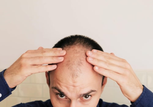 Lifestyle Factors and Male Pattern Baldness: A Comprehensive Look at Causes and Risk Factors