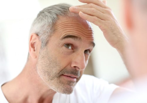 Natural Remedies for Male Pattern Baldness: A Comprehensive Guide